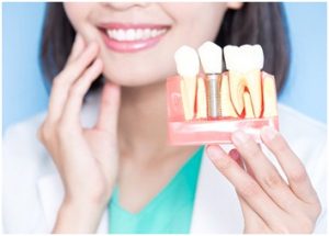 Dental implants in Tracy, CA